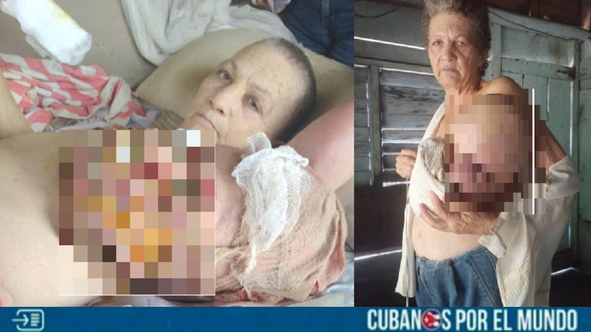Cubana tiene tres años sufriendo con un cáncer de mama en la "potencia médica" (+Fotos fuertes)