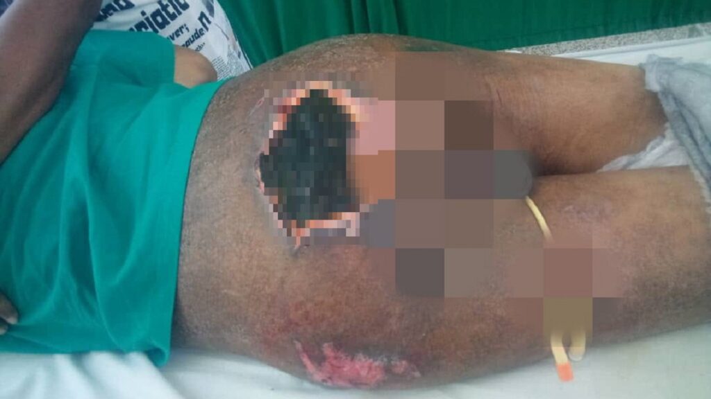 Piden medicamentos y colchón antiescaras para paciente postrado en Cuba