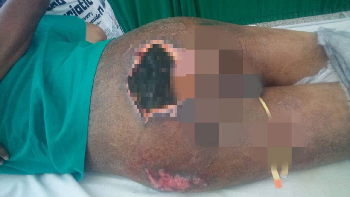 Piden medicamentos y colchón antiescaras para paciente postrado en Cuba