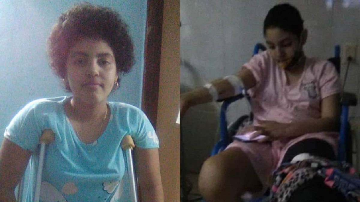 Consiguen cemento quirúrgico para prótesis de niña cubana tras denuncia por redes sociales