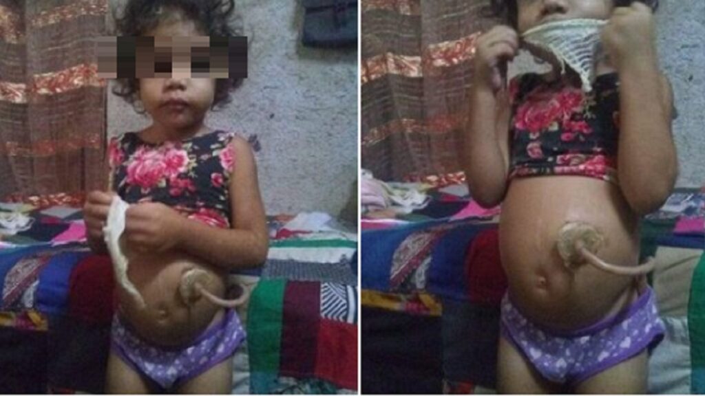 Piden sondas para niña operada de gastrostomía en Guantánamo