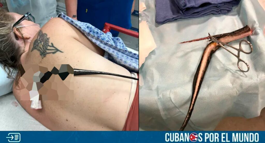 Una raya estuvo cerca de causarle la muerte a una mujer que se encontraba bañándose en una playa de Florida.