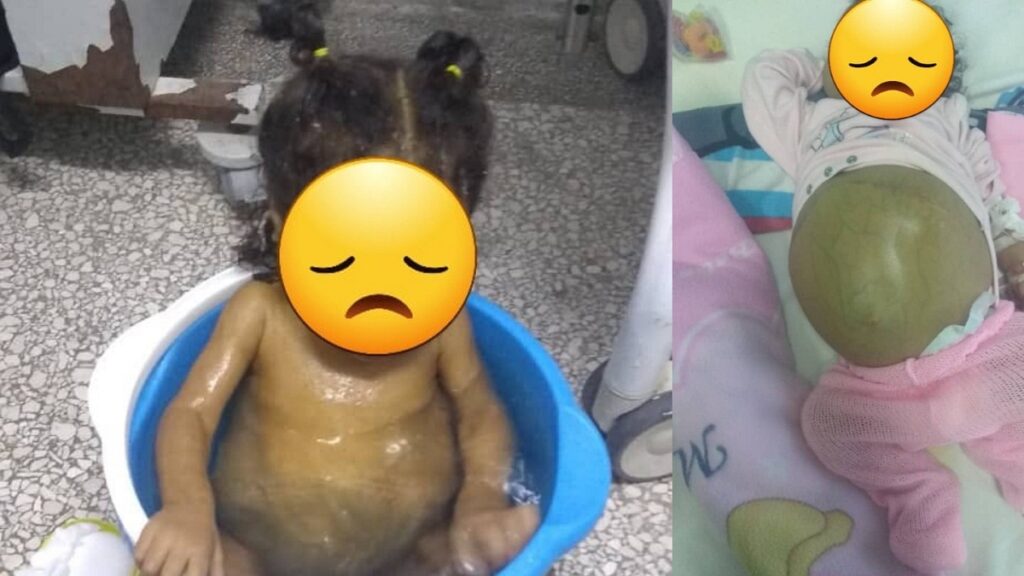 Madre cubana teme por la vida de su hija que necesita un trasplante de hígado