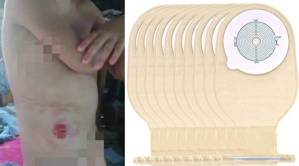 Piden bolsas de colostomía para niña en espera de cirugía en Holguín