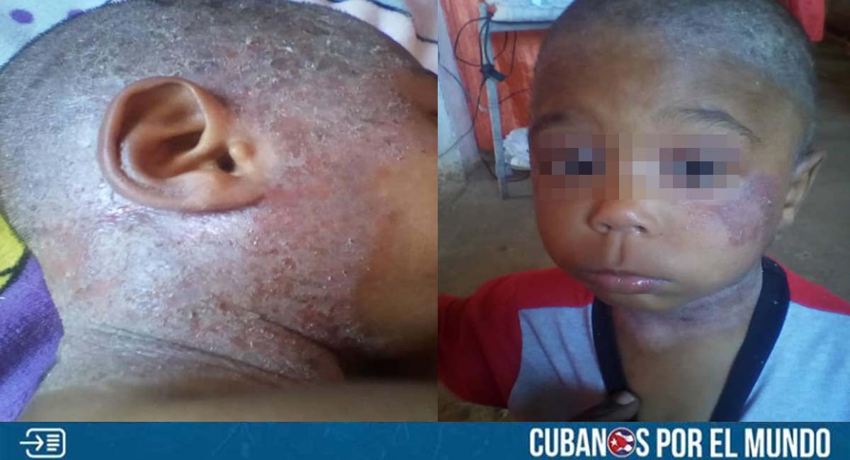 Niño cubano con enfermedad en la piel necesita ayuda
