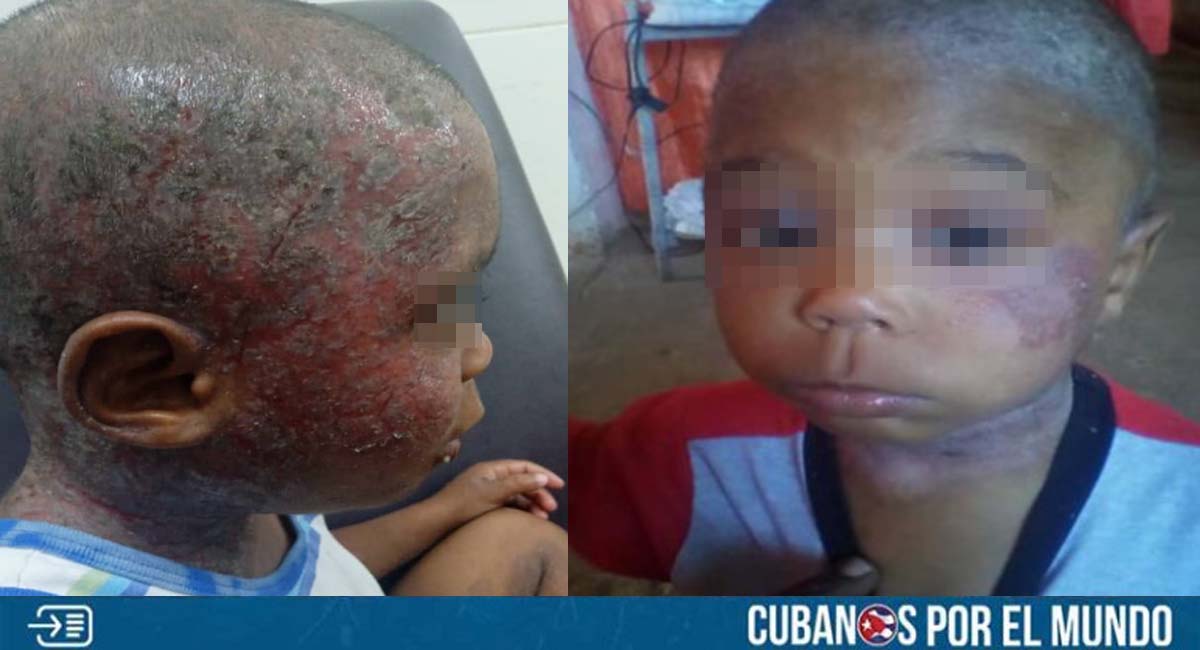 Niño cubano con enfermedad en la piel, ignorado por la “potencia médica”