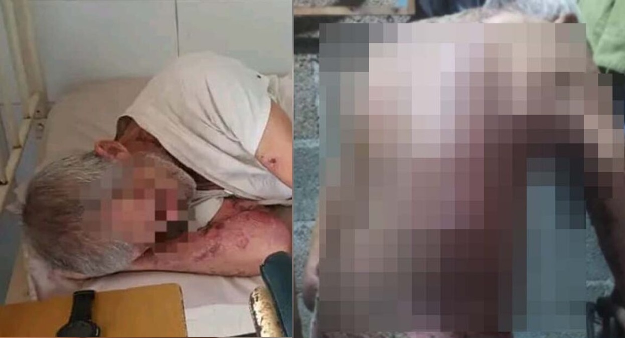 Anciano cubano que padece de pénfigo y que le habían negado la atención médica, sigue hospitalizado con recuperación lenta