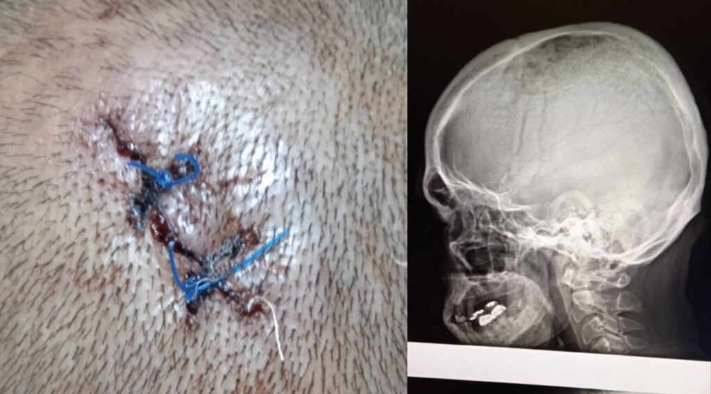 Violencia desenfrenada en Cuba: Joven recibe un batazo en la cabeza durante asalto