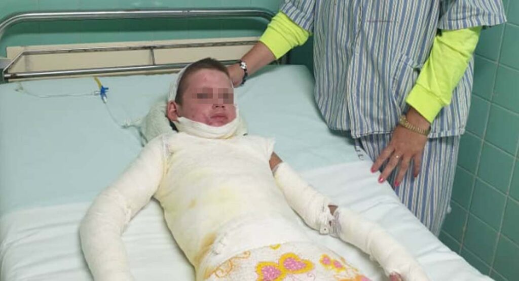 Fuera de peligro niño cubano con quemaduras graves en Ciego de Ávila