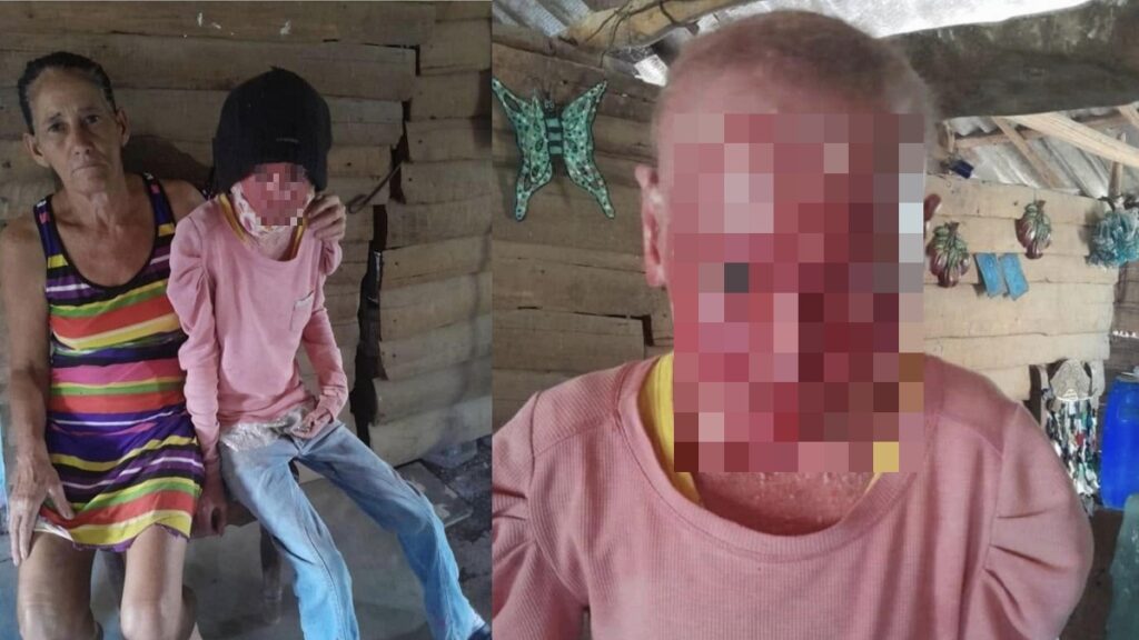 Piden ayuda para niña con enfermedad en la piel en Holguín