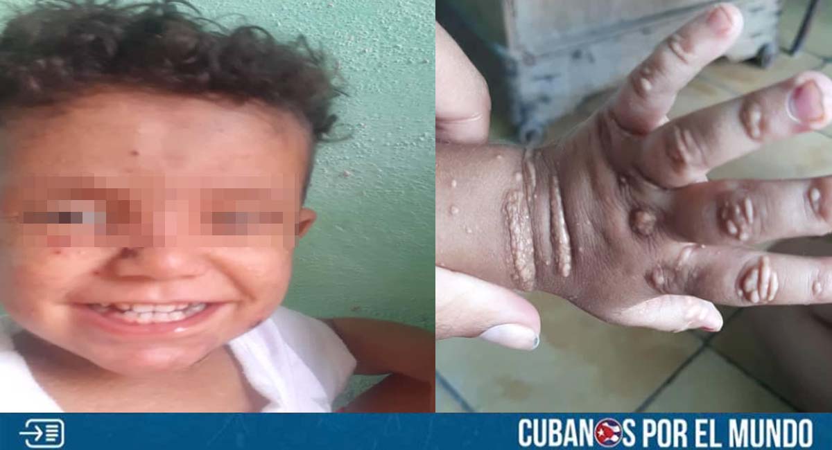 Piden ayuda urgente para niño cubano enfermo en Matanzas