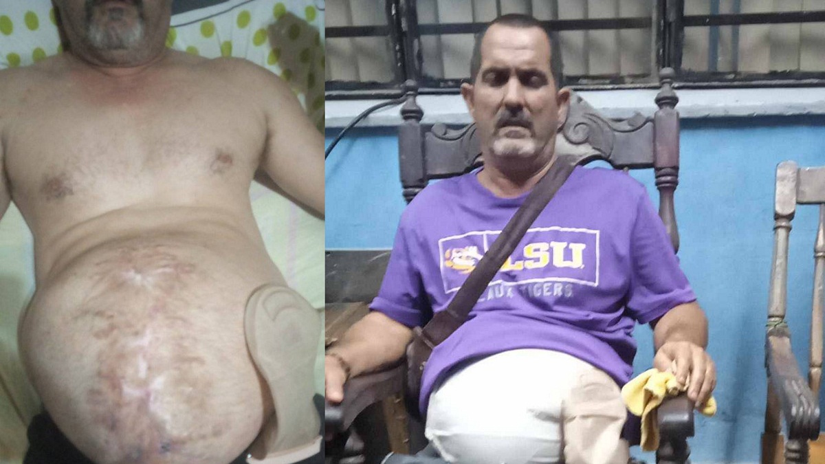 Cubano con enormes hernias pide ayuda para ser operado
