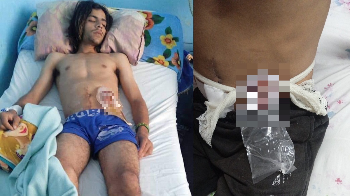 Piden ayuda para joven cubano con colostomía