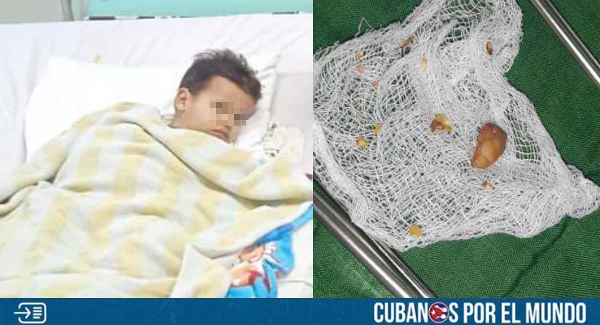 Auxilian a niño en Ciego de Ávila que aspiró un cuerpo extraño