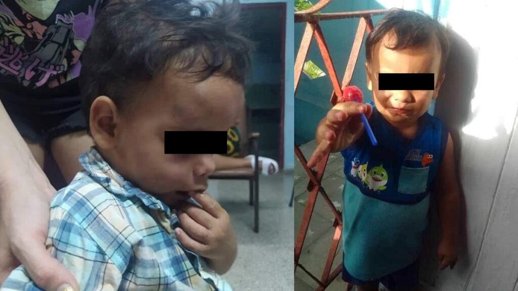 Niño cubano golpeado por su madre se recupera satisfactoriamente