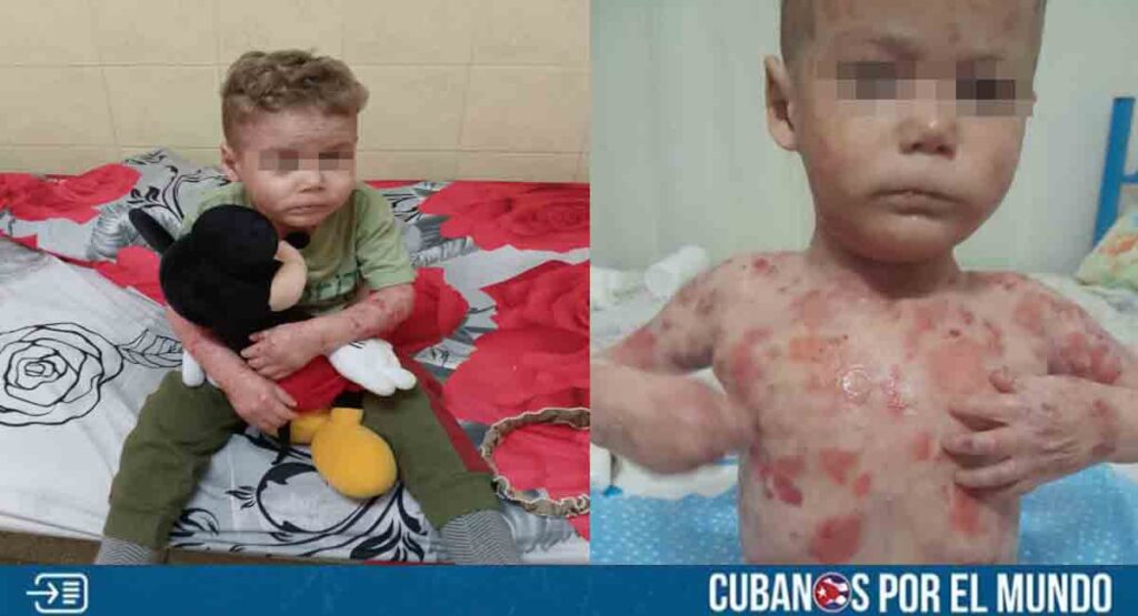 Padre cubano clama por ayuda para salvar a su hijo con rara enfermedad en la piel