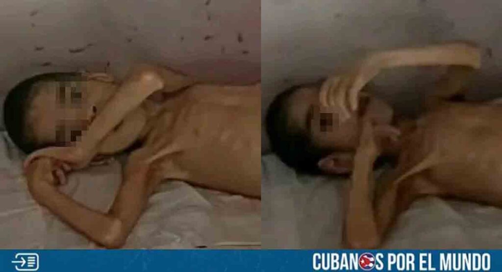 Piden ayuda para niño cubano con desnutrición